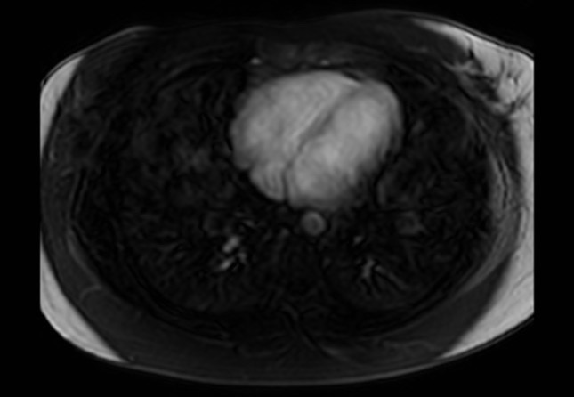 Normal liver MRI with Gadolinium (Radiopaedia 58913-66163 J 78).jpg