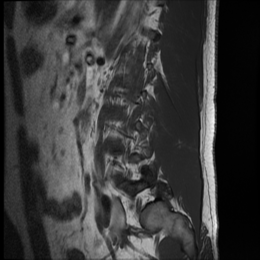 File:Normal lumbar spine MRI (Radiopaedia 35543-37039 Sagittal T1 1).png