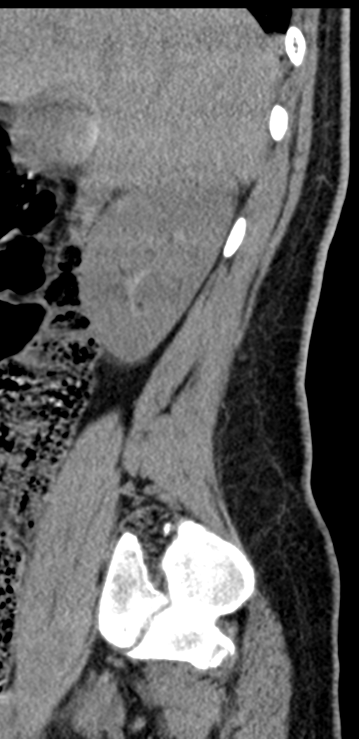 Normal lumbosacral CT (Radiopaedia 37923-39867 E 94).png