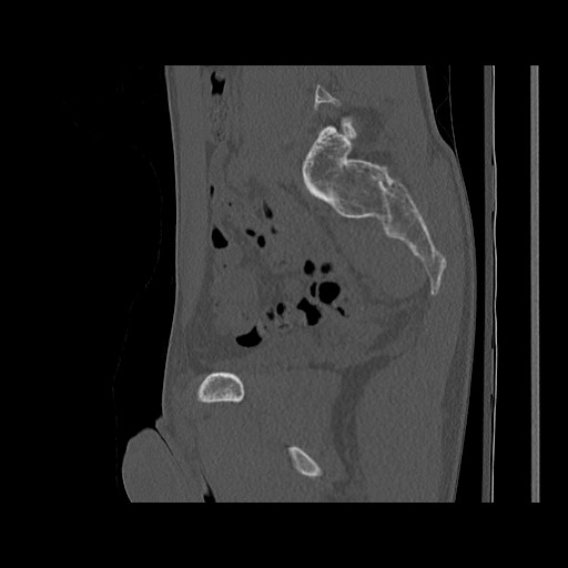 Normal pelvis (Radiopaedia 51473-57238 Sagittal bone window 60).jpg