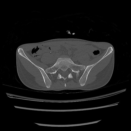 Normal pelvis CT (Radiopaedia 51471-57236 Axial bone window 24).jpg