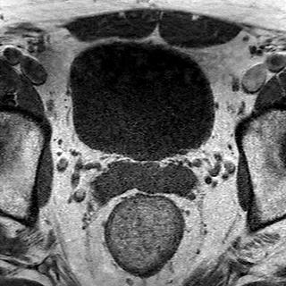 File:Normal prostate (MRI) (Radiopaedia 29986-30535 Axial T1 19).jpg