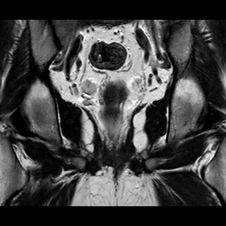 File:Normal prostate (MRI) (Radiopaedia 29986-30535 Coronal T2 15).jpg