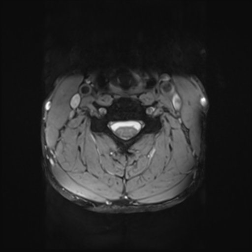 File:Normal trauma cervical spine (Radiopaedia 41017-43762 Axial T2 14).png