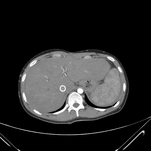 File:Nutmeg liver- Budd-Chiari syndrome (Radiopaedia 46234-50635 A 16).png
