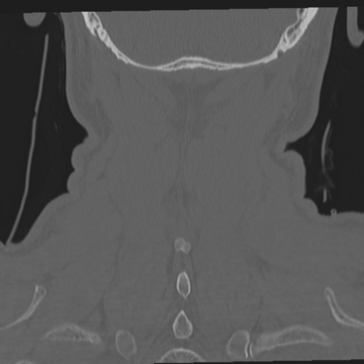 File:Occipital condyle fracture (Radiopaedia 33467-34517 Coronal bone window 60).png