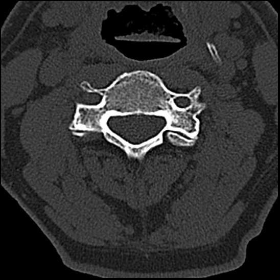 Occipital condyle fracture (type 1) (Radiopaedia 87670-104084 Axial bone window 38).jpg