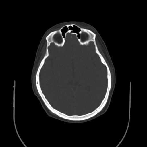Occipital spur and Currarino type A atlas anomaly (Radiopaedia 87027-103285 Coronal bone window 1).jpg