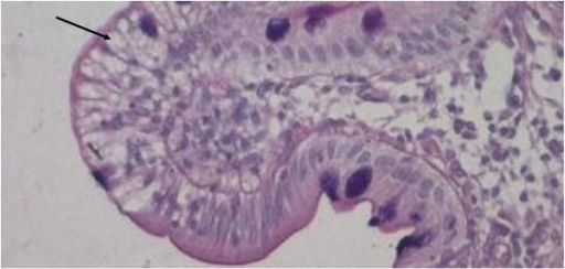 Duodenal biopsy from ABL individual shows vacuolated enterocytes