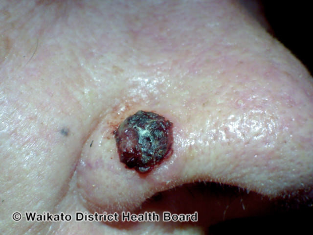 File:Pigmented basal cell carcinoma (DermNet NZ bcc-abcds-25).jpg