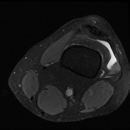 File:ACL and meniscal tears (Radiopaedia 79604-92797 Axial PD fat sat 3).jpg
