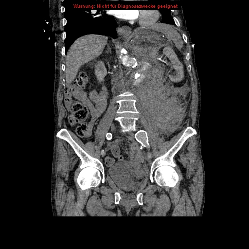 Abdominal aortic aneurysm- extremely large, ruptured (Radiopaedia 19882-19921 Coronal C+ arterial phase 57).jpg