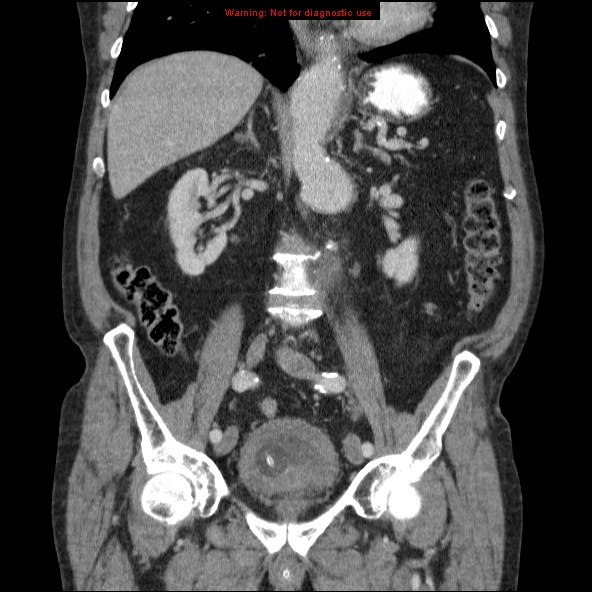 File:Abdominal aortic aneurysm (Radiopaedia 10122-10660 Coronal C+ portal venous phase 27).jpg