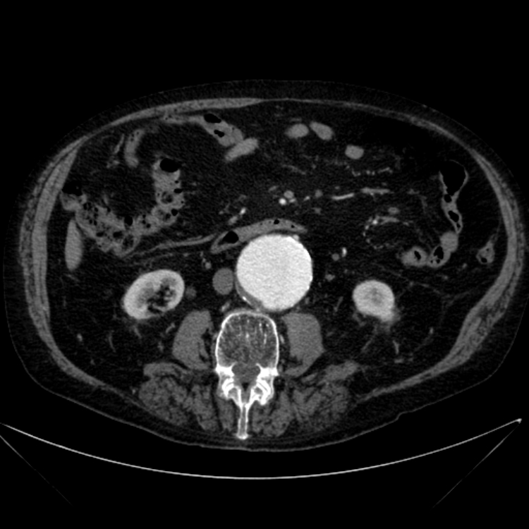 Abdominal aortic aneurysm (Radiopaedia 25855-26001 Axial C+ arterial phase 67).jpg