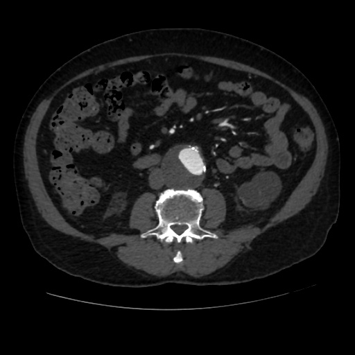 File:Abdominal aortic aneurysm (Radiopaedia 57318-64259 Axial C+ arterial phase 40).jpg