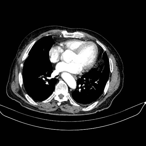 Abdominal aortic aneurysm (Radiopaedia 67117-76452 Axial C+ arterial phase 6).jpg