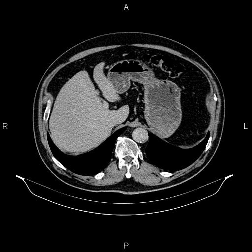 Abdominal aortic aneurysm (Radiopaedia 83094-97462 Axial renal excretory phase 27).jpg