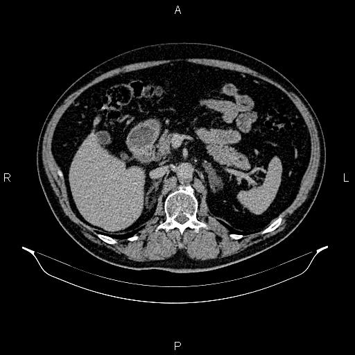 Abdominal aortic aneurysm (Radiopaedia 83094-97462 Axial renal excretory phase 38).jpg