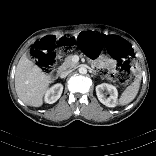 Abdominal aortic aneurysm (Radiopaedia 83581-98689 Axial C+ portal venous phase 41).jpg