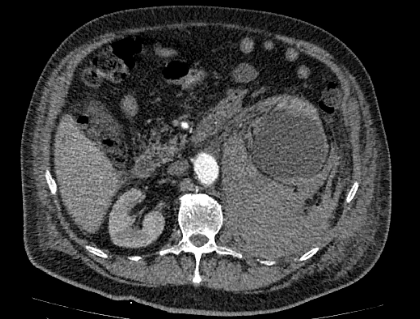 Abdominal aortic aneurysm rupture (Radiopaedia 54179-60362 Axial C+ arterial phase 29).jpg
