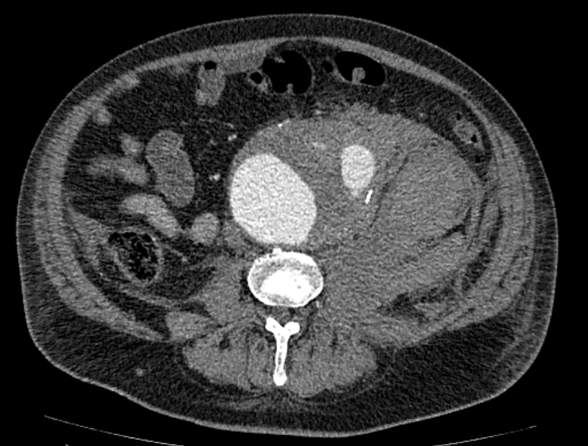 Abdominal aortic aneurysm rupture (Radiopaedia 54179-60362 Axial C+ portal venous phase 17).jpg