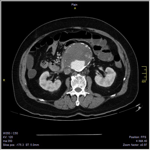 Abdominal aortic aneurysm with thrombus fissuration (Radiopaedia 47340-51926 Axial C+ arterial phase 24).jpg