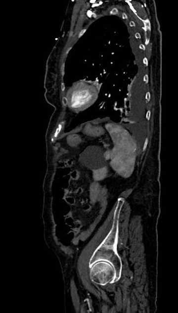 Abdominal aortic aneurysm with thrombus fissuration (Radiopaedia 73192-83919 Sagittal C+ arterial phase 24).jpg
