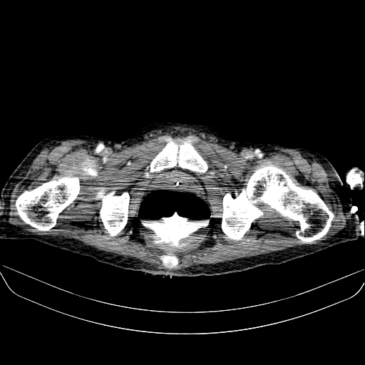 File:Abdominal collection due to previous cecal perforation (Radiopaedia 80831-94320 Axial C+ portal venous phase 209).jpg
