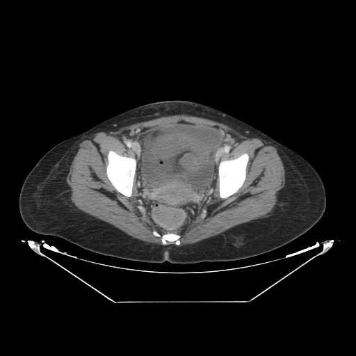 Abdominal gossypiboma- surgical towel (Radiopaedia 57288-64226 Axial C+ portal venous phase 67).jpg
