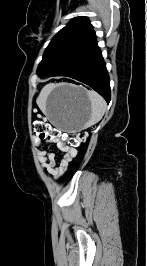 Abdominal hydatid disease (Radiopaedia 68223-77737 Sagittal C+ portal venous phase 10).jpg