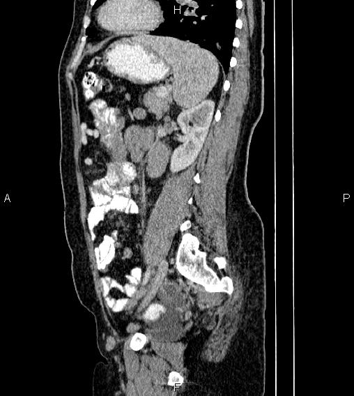 Abdominal lymphoma with sandwich sign (Radiopaedia 84378-99704 Sagittal C+ portal venous phase 62).jpg