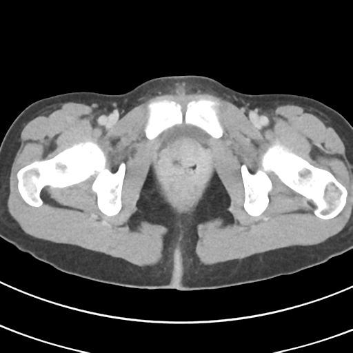 File:Abdominal multi-trauma - devascularised kidney and liver, spleen and pancreatic lacerations (Radiopaedia 34984-36486 Axial C+ delayed 81).png