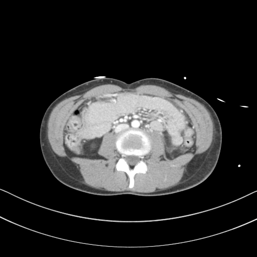 Abdominal multi-trauma - devascularised kidney and liver, spleen and pancreatic lacerations (Radiopaedia 34984-36486 Axial C+ portal venous phase 44).png