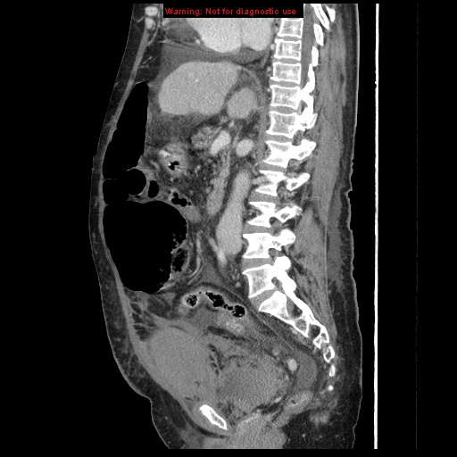 File:Abdominal wall hematoma (Radiopaedia 9427-10112 Sagittal C+ portal venous phase 56).jpg