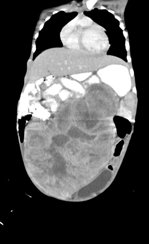Abdominopelvic rhabdomyosarcoma (Radiopaedia 78356-90984 Coronal C+ portal venous phase 27).jpg