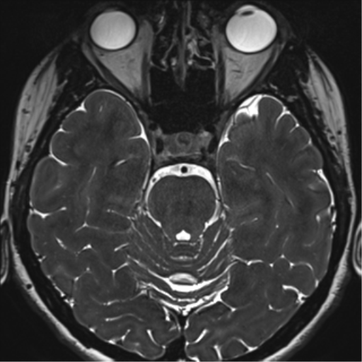 Abducens nerve palsy (Radiopaedia 51069-56648 Axial T2 fat sat 49).png