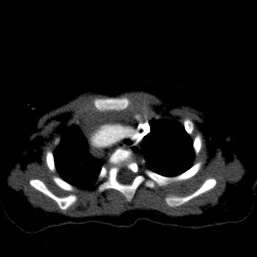 File:Aberrant left pulmonary artery (pulmonary sling) (Radiopaedia 42323-45435 Axial C+ CTPA 13).jpg