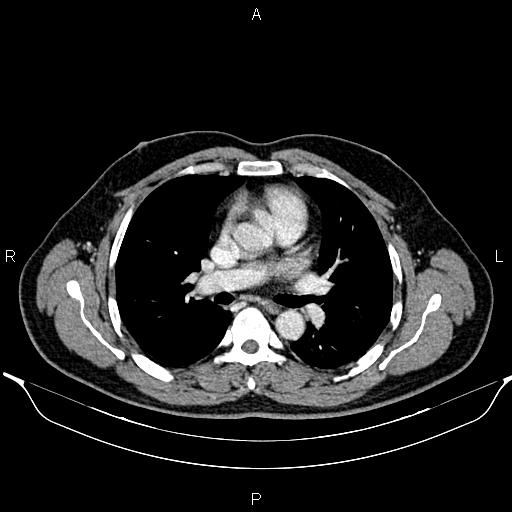 File:Aberrant right subclavian artery (Radiopaedia 87093-103354 Axial With contrast 52).jpg