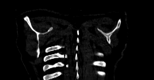 Accesory rib joint (Radiopaedia 71987-82452 Coronal bone window 89).jpg