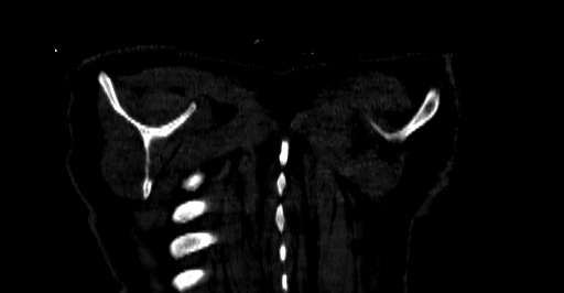 Accesory rib joint (Radiopaedia 71987-82452 Coronal bone window 95).jpg