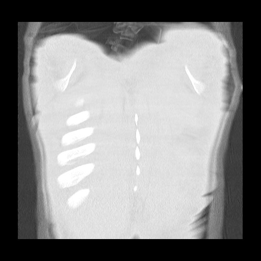 Accessory left horizontal fissure with lingular pneumonia (Radiopaedia 53763-59843 Coronal lung window 43).jpg