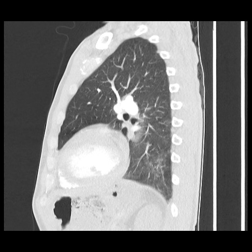 Accessory left horizontal fissure with lingular pneumonia (Radiopaedia 53763-59843 Sagittal lung window 45).jpg