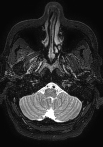 Accessory middle cerebral artery (Radiopaedia 73114-83828 Axial T2 200).jpg
