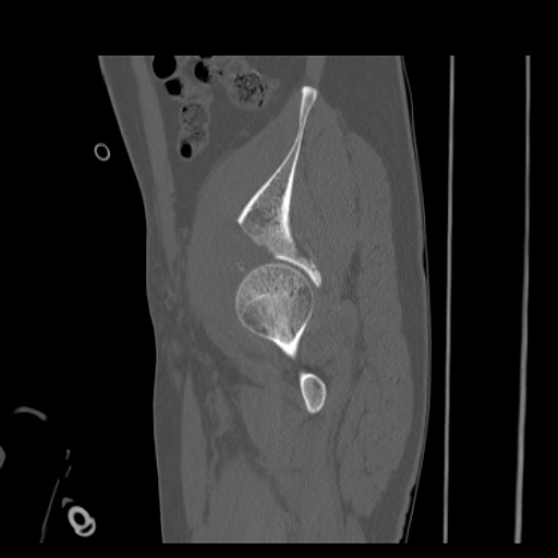 Acetabular and ilial fractures (Radiopaedia 59084-66378 Sagittal bone window 22).jpg