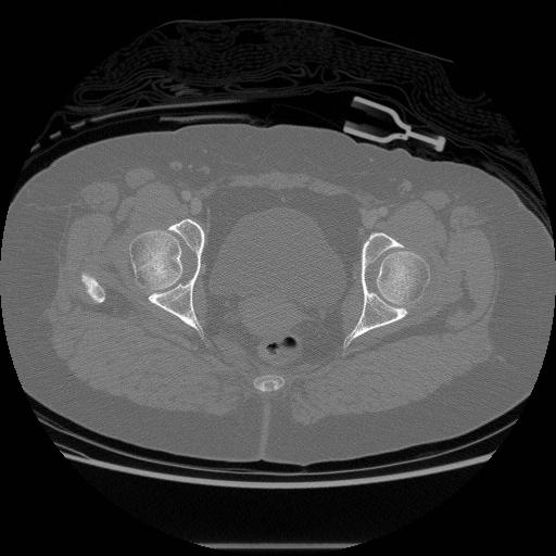 File:Acetabular fracture (Radiopaedia 13193-13212 Axial bone window 25).jpg