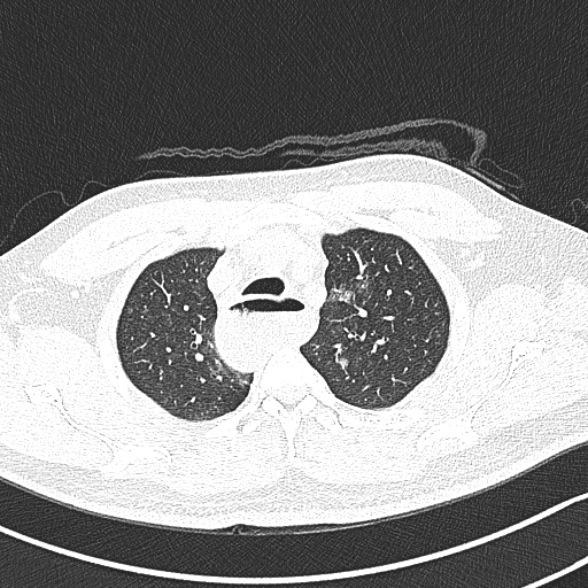 Achalasia with aspiration (Radiopaedia 55413-61845 Axial lung window 14).jpg