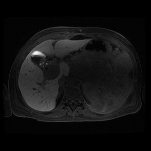 Acinar cell carcinoma of the pancreas (Radiopaedia 75442-86668 Axial late phase (~30 mins) 88).jpg