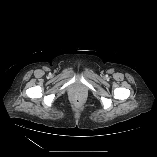 Acinar cell carcinoma of the pancreas (Radiopaedia 75442-86669 Axial C+ portal venous phase 154).jpg