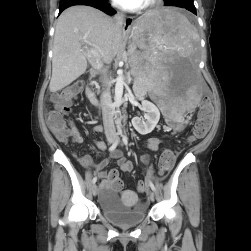 Acinar cell carcinoma of the pancreas (Radiopaedia 75442-86669 Coronal C+ portal venous phase 64).jpg