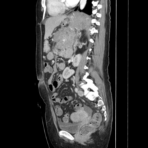 Acinar cell carcinoma of the pancreas (Radiopaedia 75442-86669 Sagittal C+ portal venous phase 110).jpg